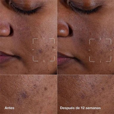 SÉRUM CLINIQUE CLEARING 30 ML - 5